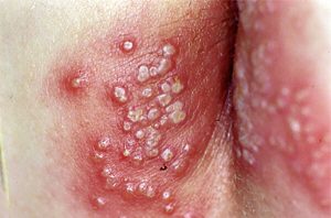 Affordable procedures for genital warts laser in Mashhad